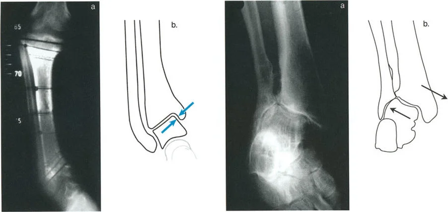 صورة طبية: الاستاذ الدكتور محمد هطيف: دليل شامل لتشوهات قصبة الساق البعيدة والكاحل في صنعاء