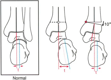 صورة طبية: الاستاذ الدكتور محمد هطيف: دليل شامل لتشوهات قصبة الساق البعيدة والكاحل في صنعاء