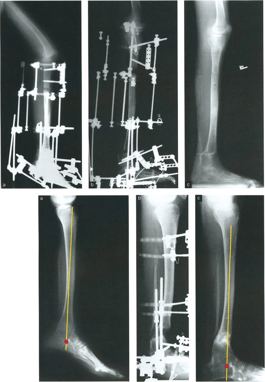 صورة طبية: الاستاذ الدكتور محمد هطيف: دليل شامل لتشوهات قصبة الساق البعيدة والكاحل في صنعاء