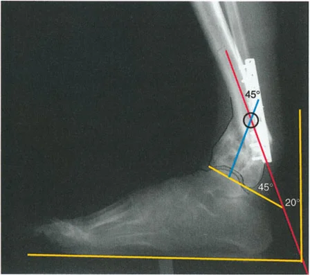 صورة طبية: الاستاذ الدكتور محمد هطيف: دليل شامل لتشوهات قصبة الساق البعيدة والكاحل في صنعاء