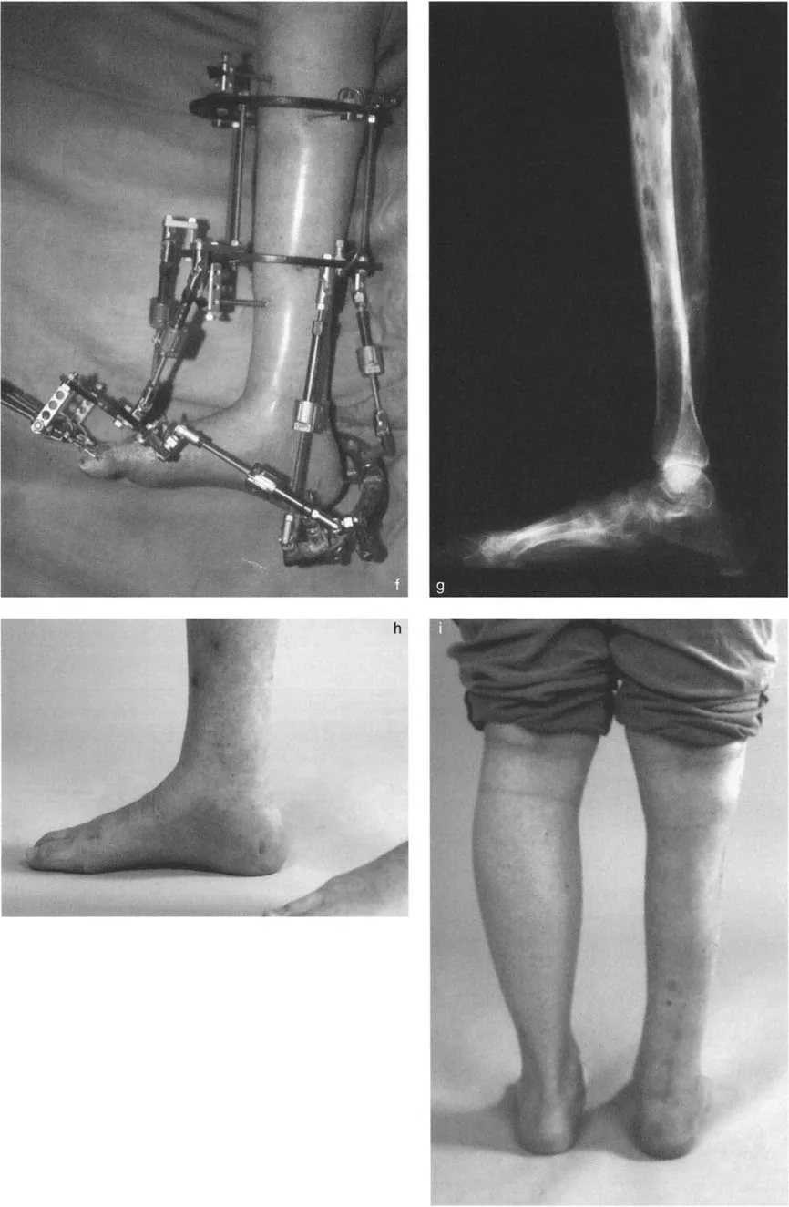 صورة طبية: تشوهات الكاحل والقدم: الأسباب، التشخيص، والعلاج المتقدم مع الأستاذ الدكتور محمد هطيف في صنعاء