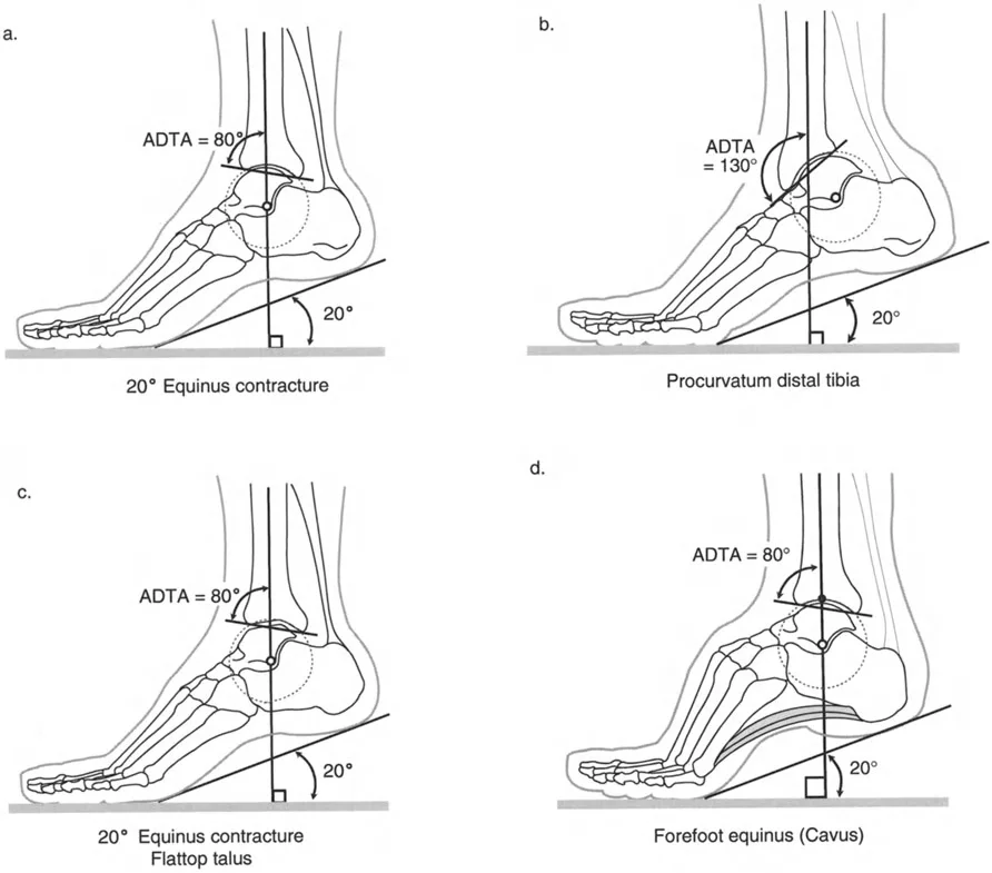 Chapter 64: · AnkleandFootConsiderations