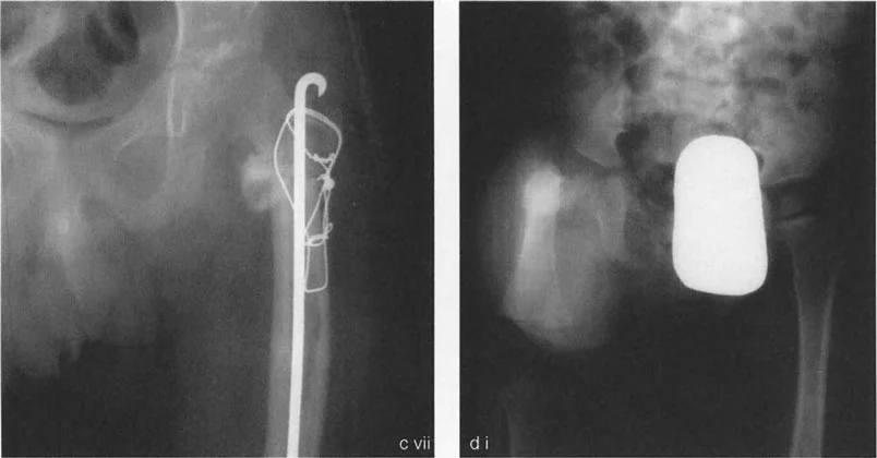 صورة توضيحية لـ جراحة عظم الفخذ التقويمية للورك: حلول متقدمة لتشوهات الورك مع الأستاذ الدكتور محمد هطيف
