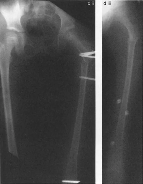 صورة طبية: جراحة عظم الفخذ التقويمية للورك: حلول متقدمة لتشوهات الورك مع الأستاذ الدكتور محمد هطيف