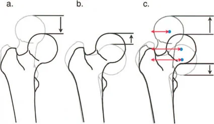 صورة طبية: جراحة عظم الفخذ التقويمية للورك: حلول متقدمة لتشوهات الورك مع الأستاذ الدكتور محمد هطيف