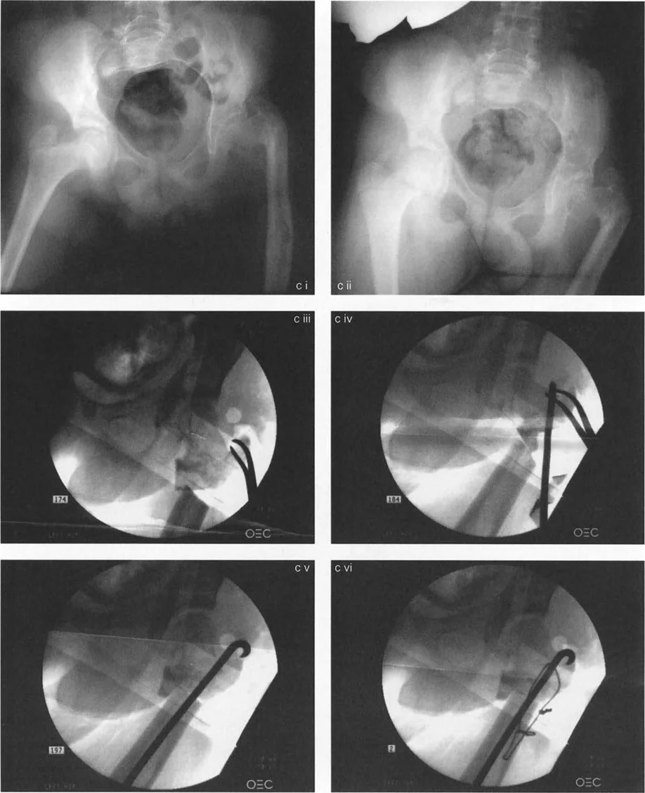 صورة توضيحية لـ جراحة عظم الفخذ التقويمية للورك: حلول متقدمة لتشوهات الورك مع الأستاذ الدكتور محمد هطيف