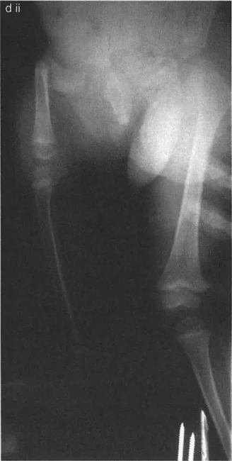 صورة توضيحية لـ جراحة عظم الفخذ التقويمية للورك: حلول متقدمة لتشوهات الورك مع الأستاذ الدكتور محمد هطيف