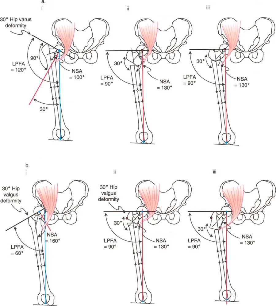 صورة طبية: جراحة عظم الفخذ التقويمية للورك: حلول متقدمة لتشوهات الورك مع الأستاذ الدكتور محمد هطيف