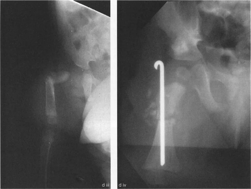 صورة توضيحية لـ جراحة عظم الفخذ التقويمية للورك: حلول متقدمة لتشوهات الورك مع الأستاذ الدكتور محمد هطيف