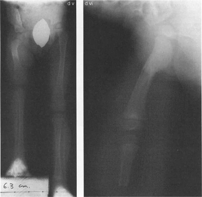 صورة طبية: جراحة عظم الفخذ التقويمية للورك: حلول متقدمة لتشوهات الورك مع الأستاذ الدكتور محمد هطيف