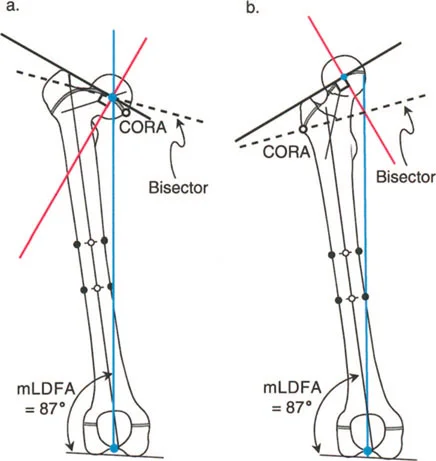 صورة طبية: جراحة عظم الفخذ التقويمية للورك: حلول متقدمة لتشوهات الورك مع الأستاذ الدكتور محمد هطيف