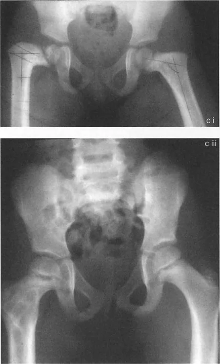 صورة طبية: جراحة عظم الفخذ التقويمية للورك: حلول متقدمة لتشوهات الورك مع الأستاذ الدكتور محمد هطيف