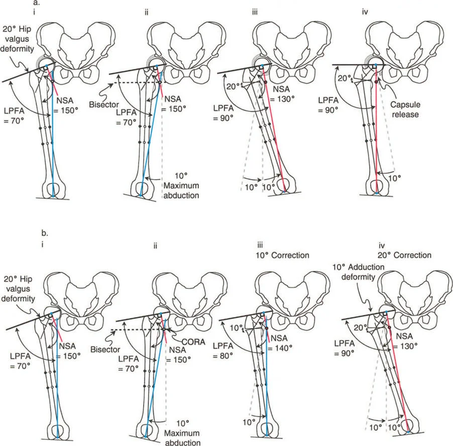 صورة طبية: جراحة عظم الفخذ التقويمية للورك: حلول متقدمة لتشوهات الورك مع الأستاذ الدكتور محمد هطيف