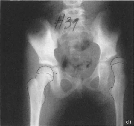 صورة طبية: جراحة عظم الفخذ التقويمية للورك: حلول متقدمة لتشوهات الورك مع الأستاذ الدكتور محمد هطيف