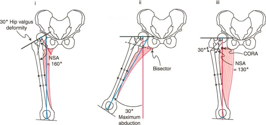 صورة طبية: جراحة عظم الفخذ التقويمية للورك: حلول متقدمة لتشوهات الورك مع الأستاذ الدكتور محمد هطيف
