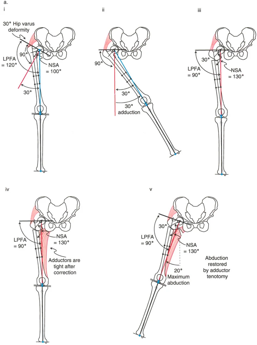 جراحة عظم الفخذ التقويمية للورك: حلول متقدمة لتشوهات الورك مع الأستاذ الدكتور محمد هطيف