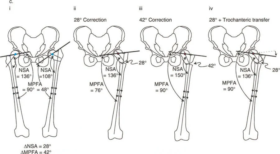 دليلك الشامل لتصحيح تشوهات عظم الفخذ القريب: استعادة وظيفة مفصل الورك والمشي الطبيعي في صنعاء
