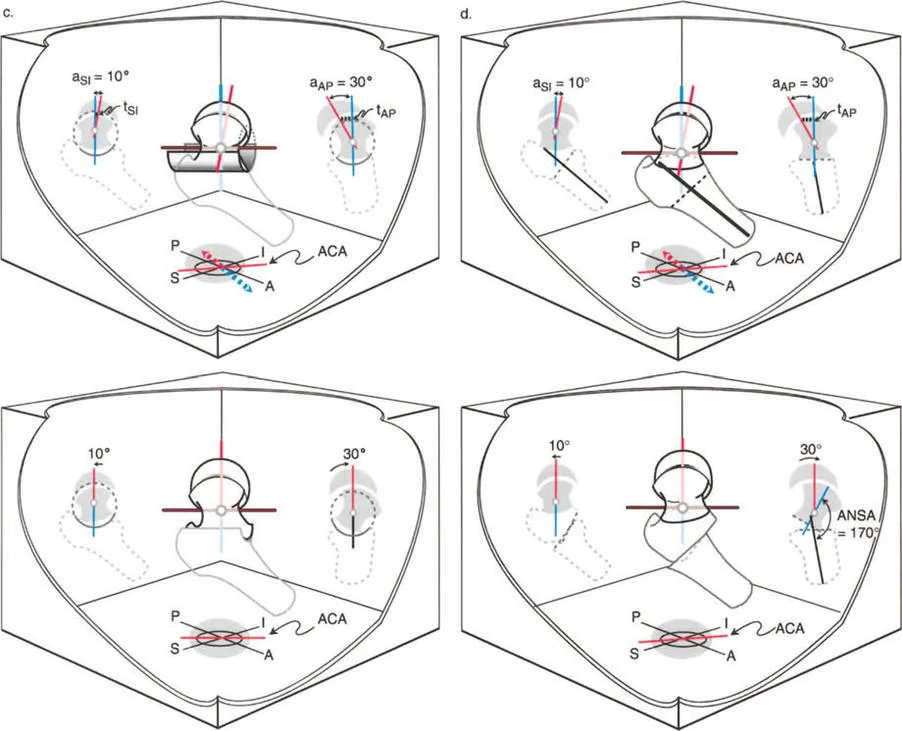 صورة طبية: دليلك الشامل لتصحيح تشوهات مفصل الورك: من التشخيص إلى التعافي مع الأستاذ الدكتور محمد هطيف في صنعاء
