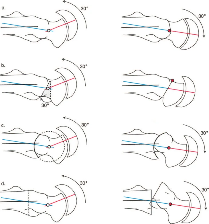 صورة طبية: دليلك الشامل لتصحيح تشوهات مفصل الورك: من التشخيص إلى التعافي مع الأستاذ الدكتور محمد هطيف في صنعاء