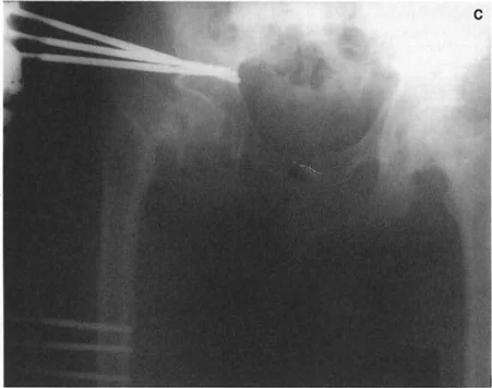 صورة توضيحية لتجنب فخ الالتواء