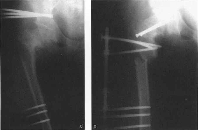 صورة طبية: دليلك الشامل لتصحيح تشوهات مفصل الورك: من التشخيص إلى التعافي مع الأستاذ الدكتور محمد هطيف في صنعاء