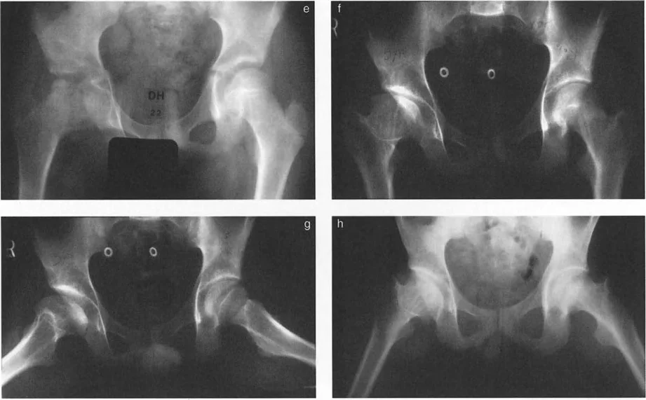 صورة طبية: دليلك الشامل لتصحيح تشوهات مفصل الورك: من التشخيص إلى التعافي مع الأستاذ الدكتور محمد هطيف في صنعاء
