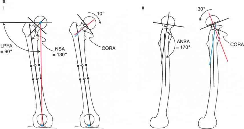 صورة توضيحية لـ دليلك الشامل لتصحيح تشوهات مفصل الورك: من التشخيص إلى التعافي مع الأستاذ الدكتور محمد هطيف في صنعاء