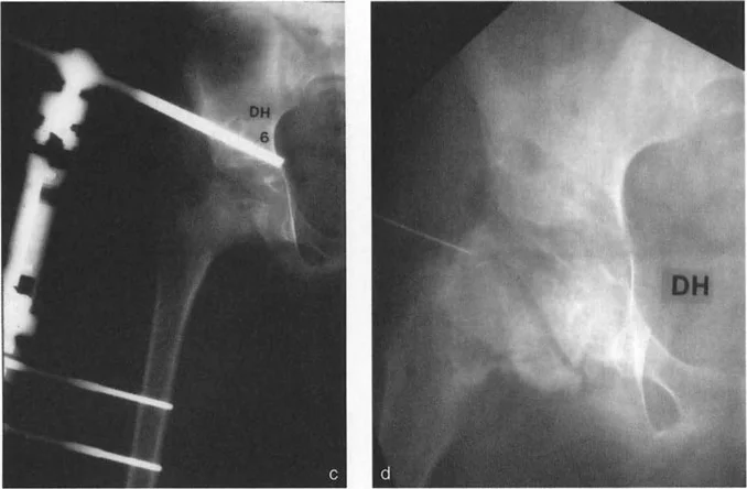 صورة طبية: دليلك الشامل لتصحيح تشوهات مفصل الورك: من التشخيص إلى التعافي مع الأستاذ الدكتور محمد هطيف في صنعاء