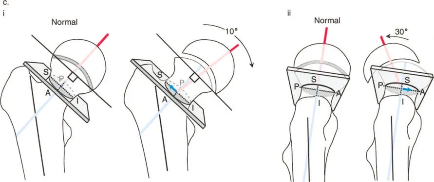 دليلك الشامل لتصحيح تشوهات مفصل الورك: من التشخيص إلى التعافي مع الأستاذ الدكتور محمد هطيف في صنعاء