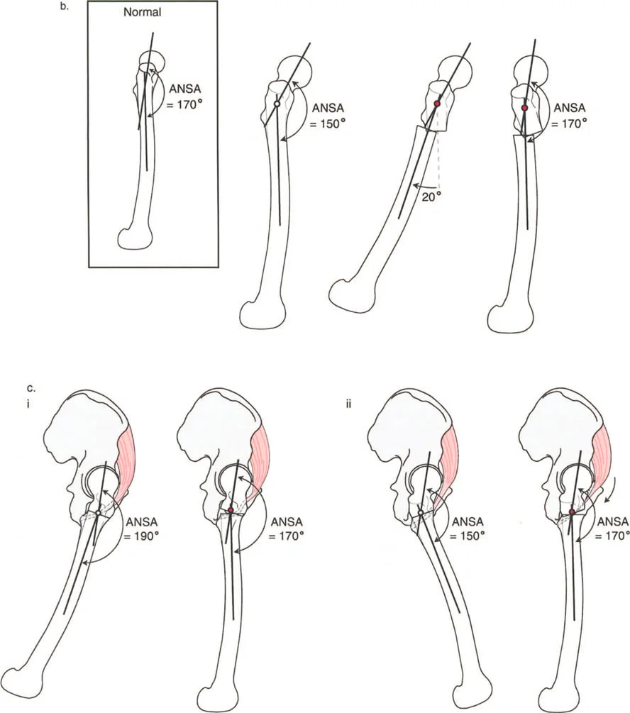 صورة طبية: دليلك الشامل لتصحيح تشوهات مفصل الورك: من التشخيص إلى التعافي مع الأستاذ الدكتور محمد هطيف في صنعاء