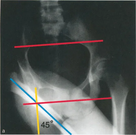 رسم توضيحي لتقييم ما قبل الجراحة لأقصى تقريب لعظم الفخذ (اختبار التقريب المتقاطع للساقين). في هذا المريض، تبلغ زاوية التقريب القصوى 45 درجة بالضبط.