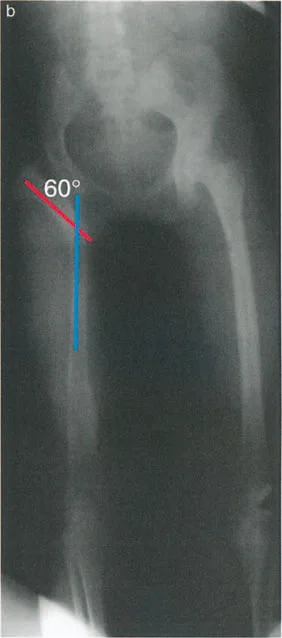 صورة أشعة سينية بعد التخطيط توضح تنفيذ القطع العظمي القريب. تم تطبيق تصحيح تقوس خارجي بزاوية 60 درجة لتوفير دعم قوي للحوض والقضاء على هبوط الحوض.