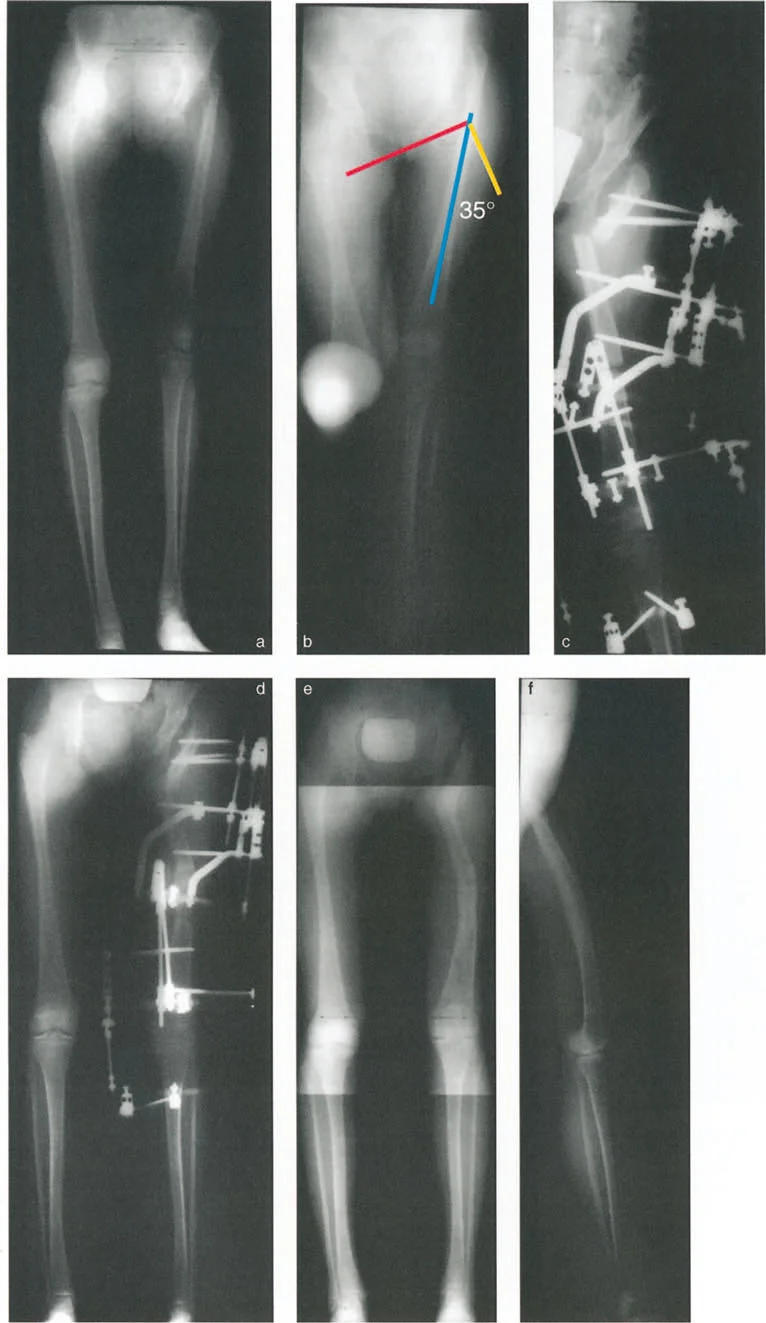 صورة توضيحية لـ جراحة دعم الحوض العظمية: حلول متقدمة للورك غير المستقر وتصحيح التشوهات مع الأستاذ الدكتور محمد هطيف في صنعاء