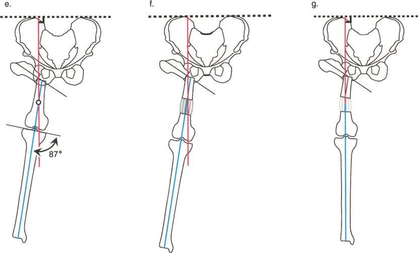صورة توضيحية لـ جراحة دعم الحوض العظمية: حلول متقدمة للورك غير المستقر وتصحيح التشوهات مع الأستاذ الدكتور محمد هطيف في صنعاء