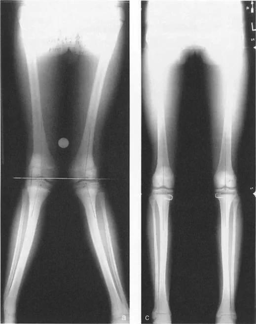 صورة توضيحية لـ صفائح النمو وتفاوت طول الأطراف: دليل شامل للتنبؤ والعلاج في صنعاء