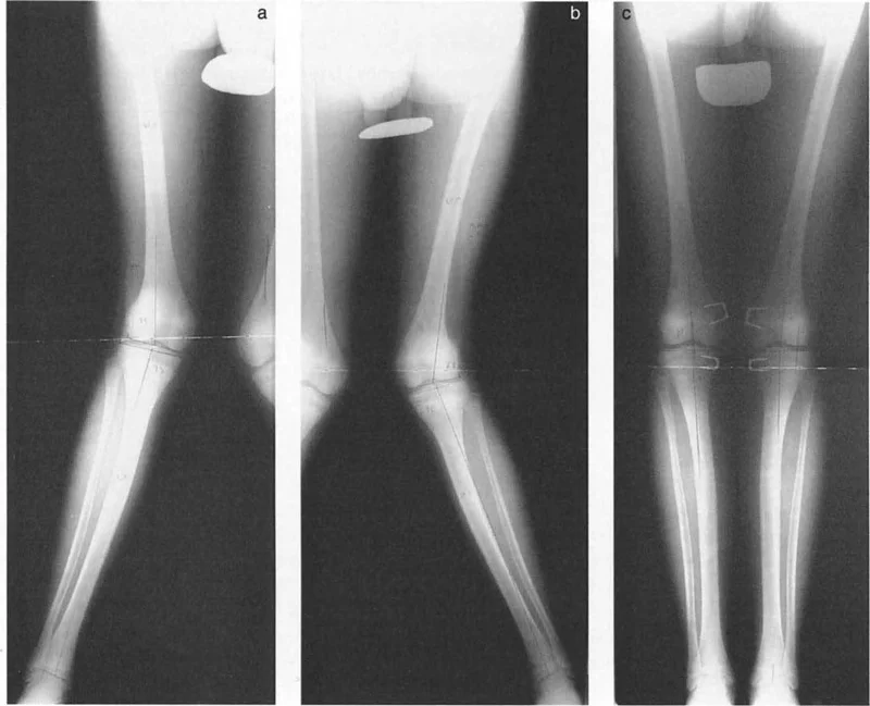 صورة توضيحية لـ صفائح النمو وتفاوت طول الأطراف: دليل شامل للتنبؤ والعلاج في صنعاء