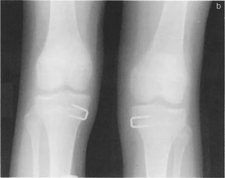 صورة توضيحية لـ صفائح النمو وتفاوت طول الأطراف: دليل شامل للتنبؤ والعلاج في صنعاء