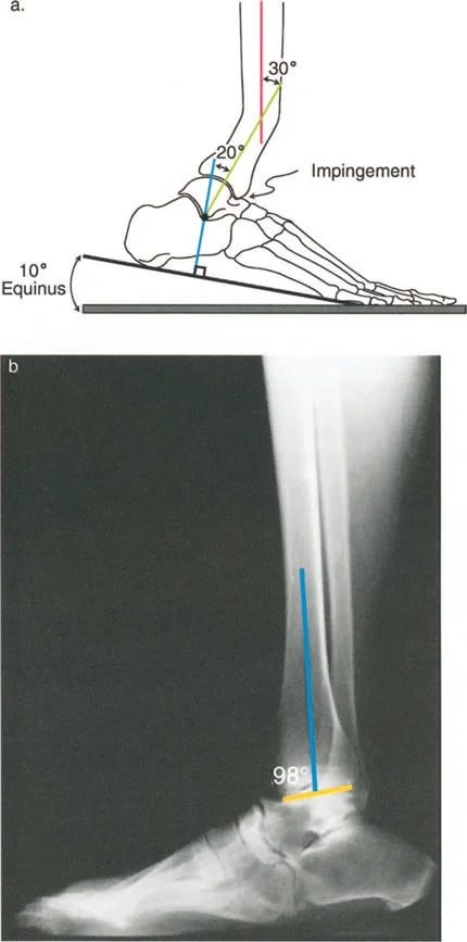 صورة طبية: إتقان ميكانيكا المشي الحيوية وتصحيح تشوهات الأطراف السفلية: نهج الأستاذ الدكتور محمد هطيف في صنعاء