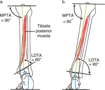 صورة توضح التعويض في الكاحل والركبة
