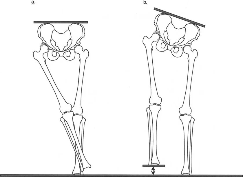 صورة طبية: إتقان ميكانيكا المشي الحيوية وتصحيح تشوهات الأطراف السفلية: نهج الأستاذ الدكتور محمد هطيف في صنعاء