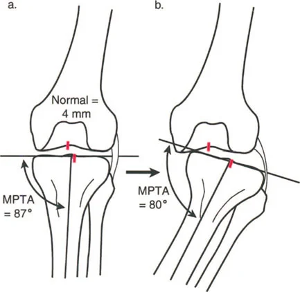 صورة طبية: إتقان ميكانيكا المشي الحيوية وتصحيح تشوهات الأطراف السفلية: نهج الأستاذ الدكتور محمد هطيف في صنعاء