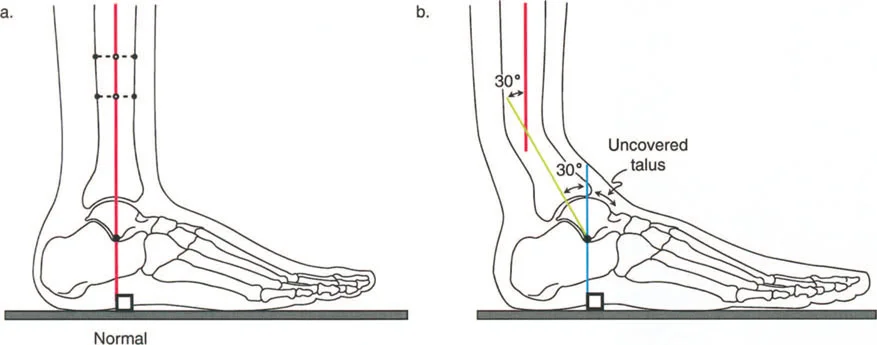 صورة طبية: إتقان ميكانيكا المشي الحيوية وتصحيح تشوهات الأطراف السفلية: نهج الأستاذ الدكتور محمد هطيف في صنعاء