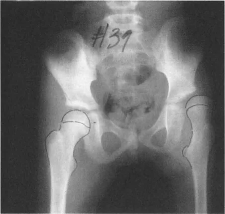 صورة طبية: إتقان ميكانيكا المشي الحيوية وتصحيح تشوهات الأطراف السفلية: نهج الأستاذ الدكتور محمد هطيف في صنعاء