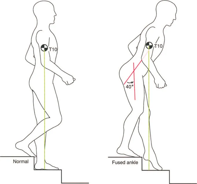 صورة توضح تأثير التشوهات على المشي