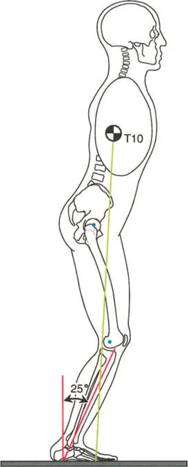 صورة طبية: إتقان ميكانيكا المشي الحيوية وتصحيح تشوهات الأطراف السفلية: نهج الأستاذ الدكتور محمد هطيف في صنعاء
