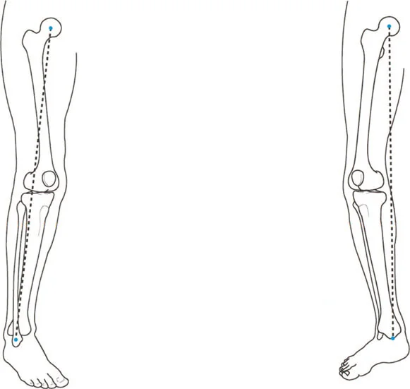 صورة توضح تأثير التشوه على مفصل الركبة