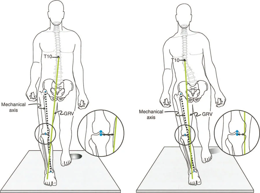 صورة طبية: إتقان ميكانيكا المشي الحيوية وتصحيح تشوهات الأطراف السفلية: نهج الأستاذ الدكتور محمد هطيف في صنعاء