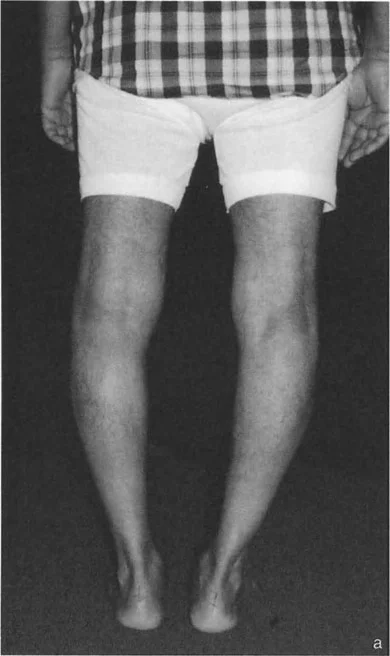 صورة توضح تشوه الانحناء الأمامي في الساق