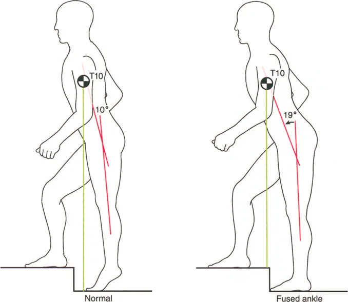 صورة طبية: إتقان ميكانيكا المشي الحيوية وتصحيح تشوهات الأطراف السفلية: نهج الأستاذ الدكتور محمد هطيف في صنعاء
