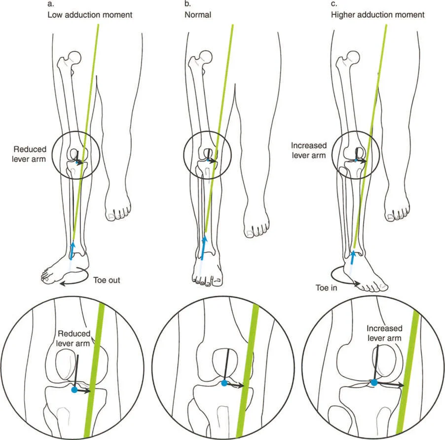 صورة طبية: إتقان ميكانيكا المشي الحيوية وتصحيح تشوهات الأطراف السفلية: نهج الأستاذ الدكتور محمد هطيف في صنعاء